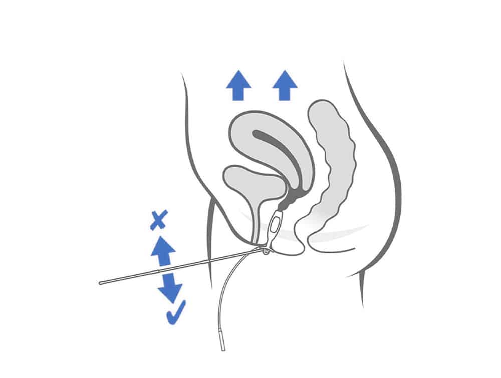 Sonde vaginale universelle Periform