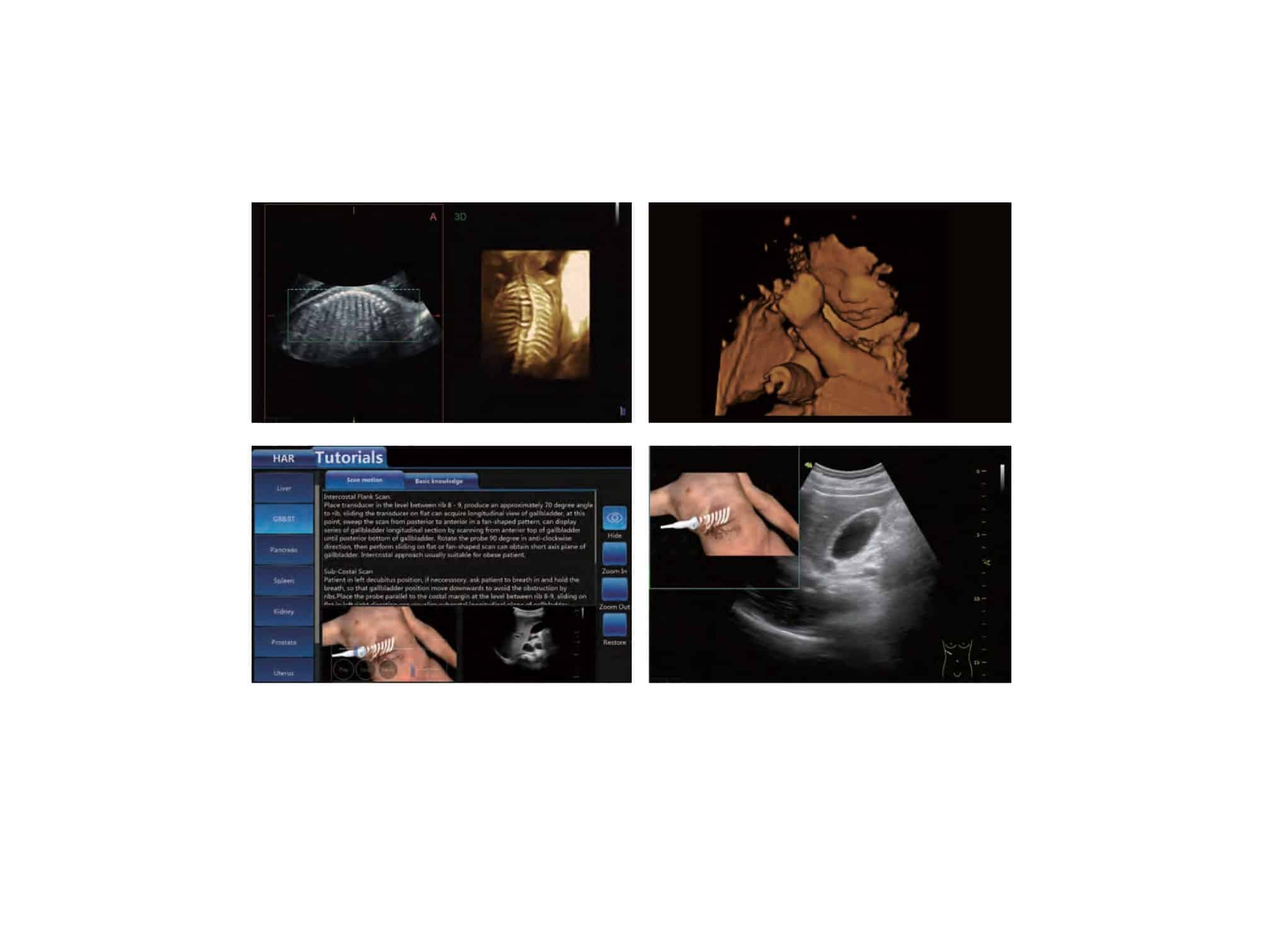Echographe sur chariot X1 +écran 15,6+ Sonde Convexe +Sonde Linéaire